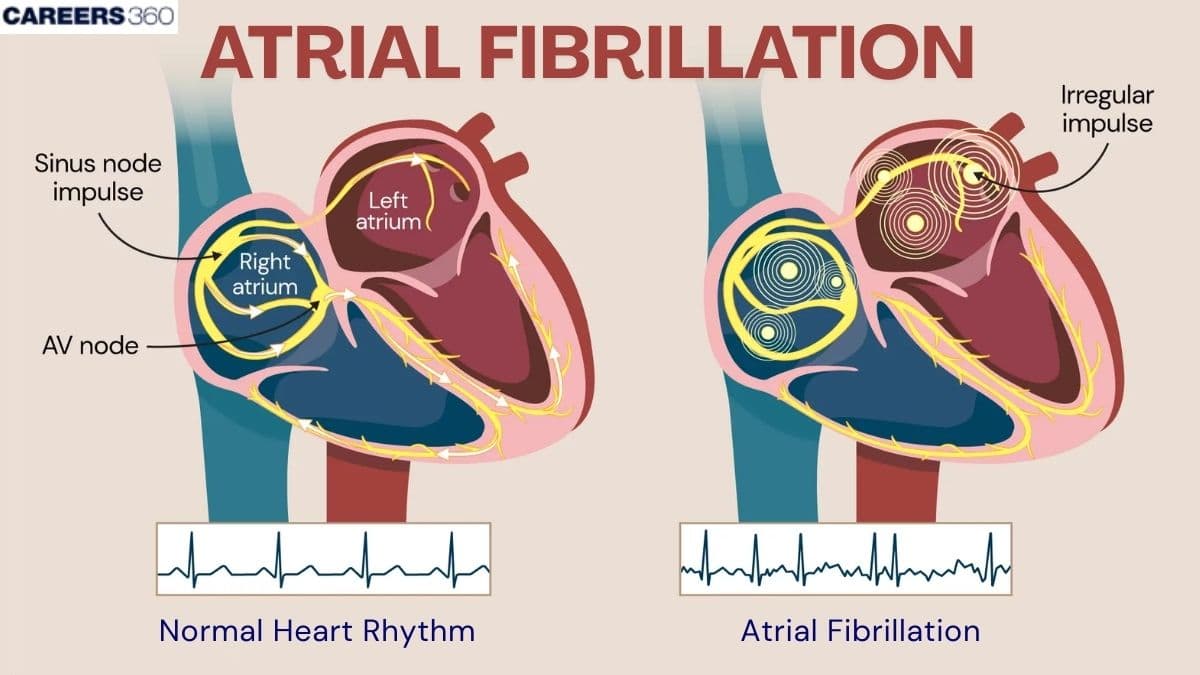 Atrial Fibrillation - Symptoms, causes & Treatment